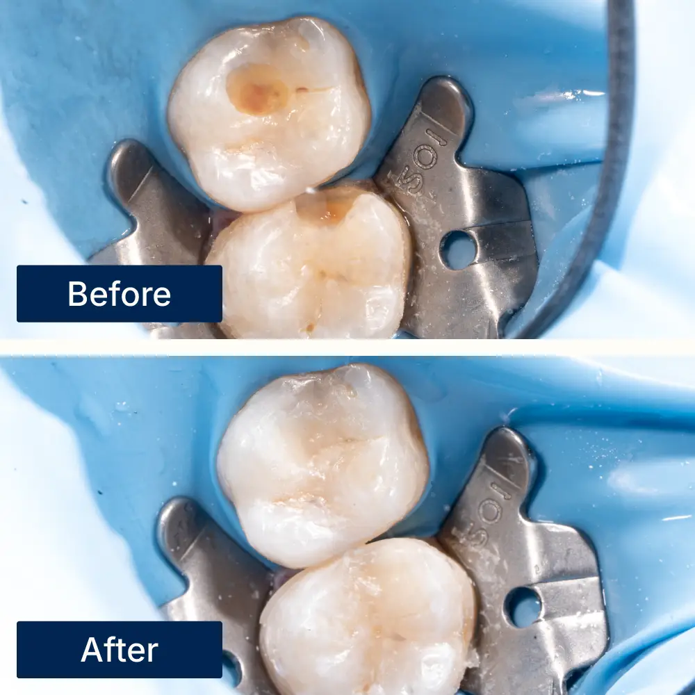 Before: Two molars with visible cavities and decay before dental filling treatment at Oralis Dental, Petaling Jaya. After: Restored molars with smooth, healthy surfaces after dental fillings at Oralis Dental — improved function and appearance.