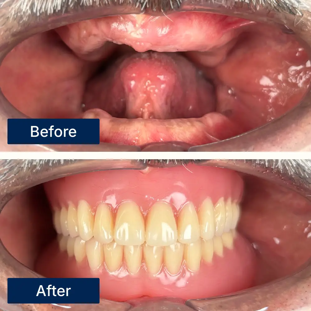 Prosthetic dentures in Kuching, Sarawak, Malaysia.