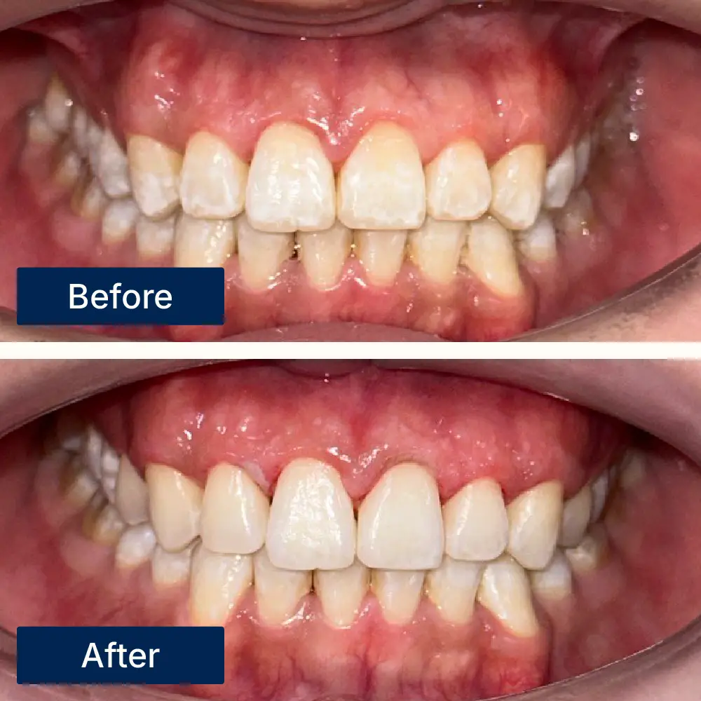 Before: Teeth with visible plaque and discoloration before scaling treatment at Oralis Dental, Petaling Jaya. After: Cleaner, whiter teeth with healthier gums after dental scaling at Oralis Dental — improved oral hygiene and appearance.
