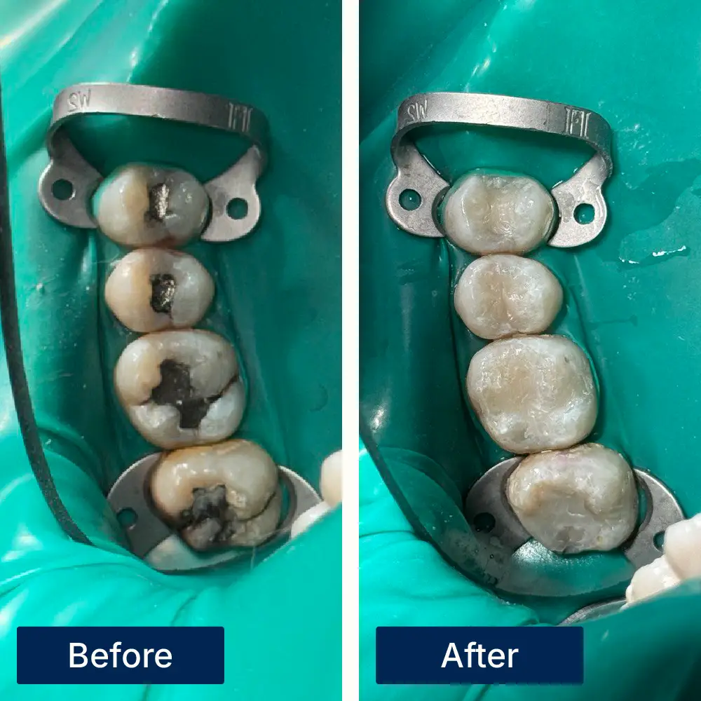 Before: Four molars with visible cavities and decay before dental filling treatment at Oralis Dental, Petaling Jaya. After: Restored molars with smooth, cavity-free surfaces after dental fillings at Oralis Dental — improved function and appearance.