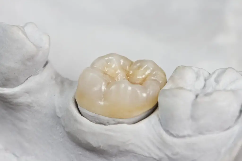 Close-up of a dental model featuring dental crowns and bridges, used to replace missing teeth. This solution is ideal for restoring a specific area with a fixed, non-removable option, provided by a trusted Dental Clinic in Petaling Jaya.