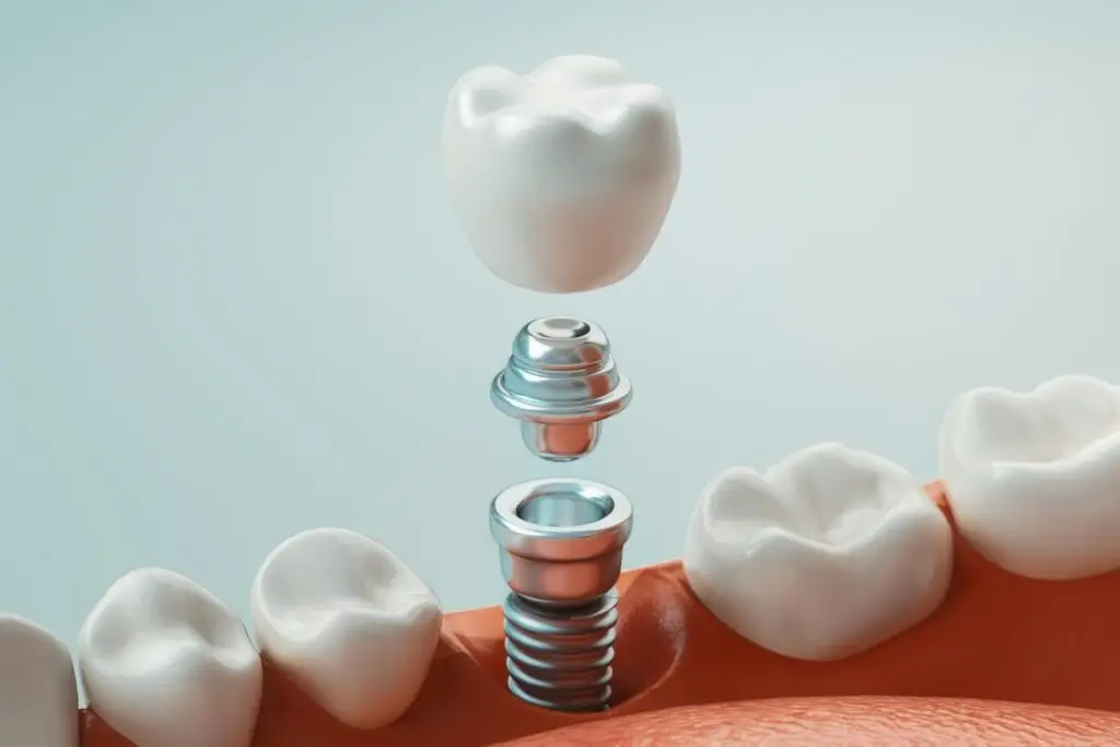Close-up of a dental implant being placed in a model of teeth, illustrating the gold standard in tooth replacement. Dental implants prevent bone loss and function like natural teeth, a solution offered at a professional Dental Clinic in Petaling Jaya.