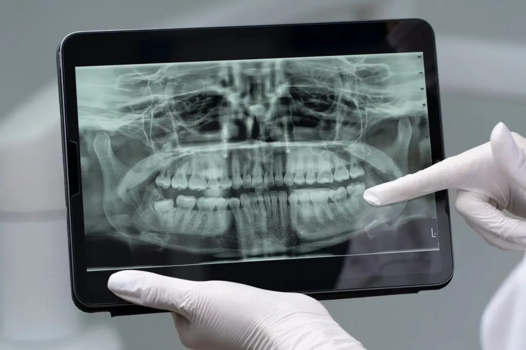 General dentistry panoramic X-ray showing full jaw and teeth for diagnostic and treatment planning at a dental clinic in Petaling Jaya.