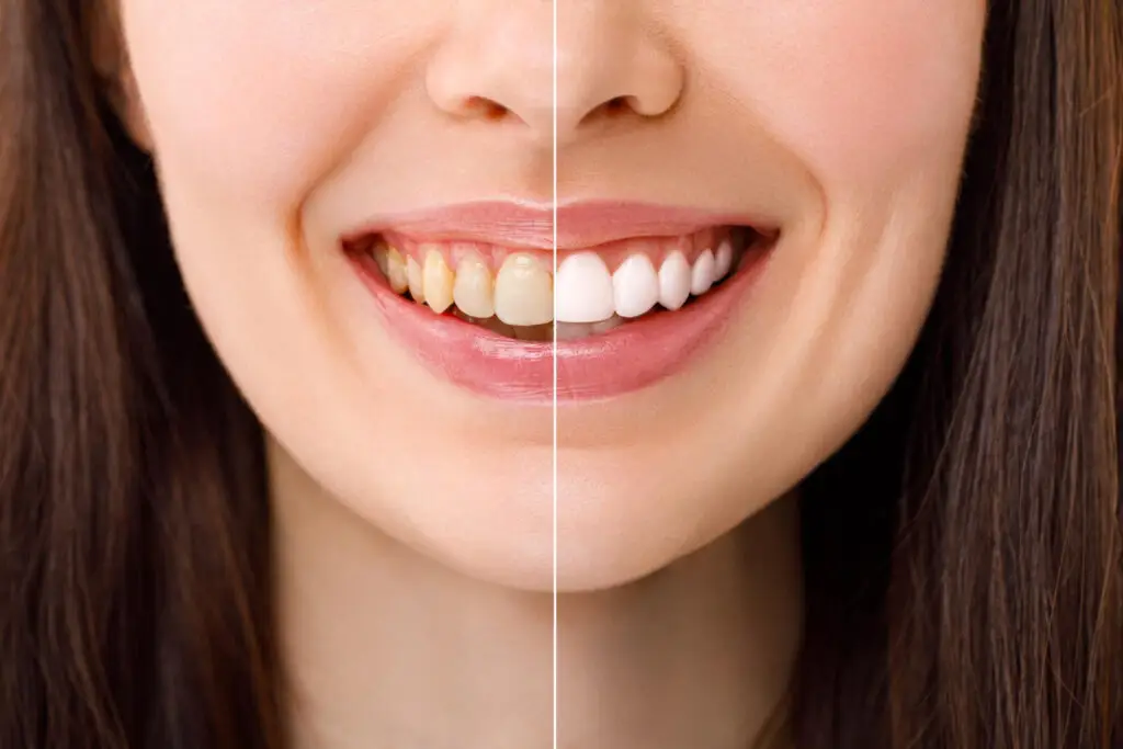 Split-face portrait showing a bright smile and whitening progress; aesthetic dental whitening service at a dental clinic in Petaling Jaya.