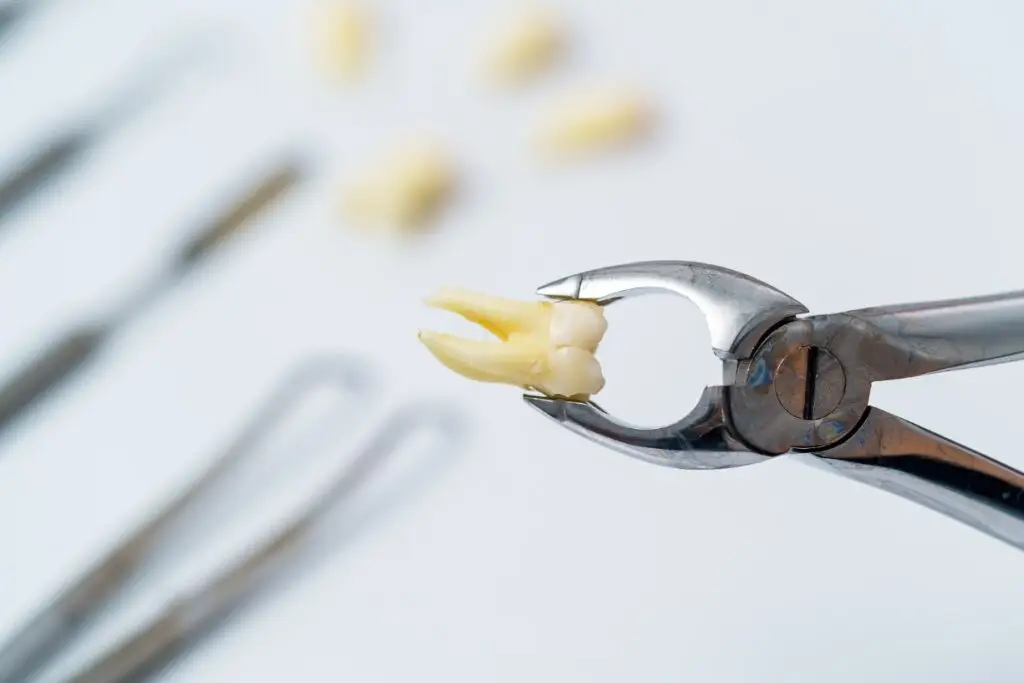 Dental professional using extraction tools near a patient’s tooth, indicating simple and surgical tooth extractions at a dental clinic in Petaling Jaya.