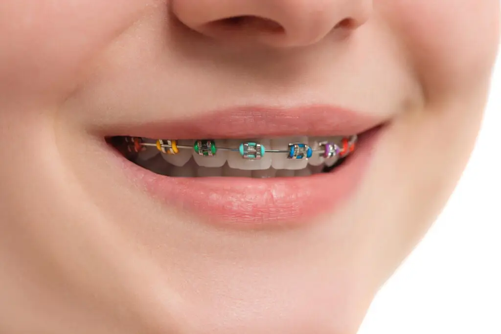 Braces and Invisalign comparison — smiling patient with traditional metal braces featuring colourful bands.