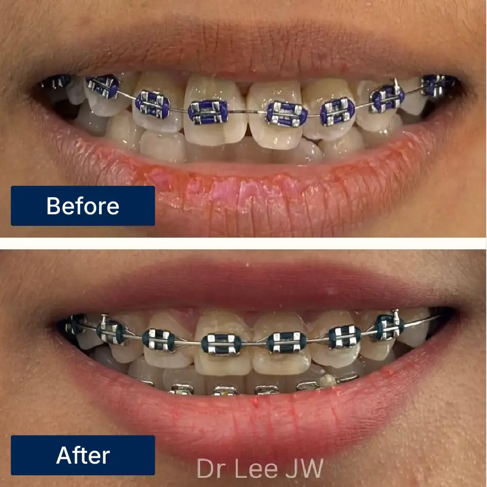 Before: Misaligned teeth with visible cavities before braces and fillings at Oralis Dental, Petaling Jaya. After: Straightened and restored teeth after combined orthodontic and restorative treatment at Oralis Dental — improved function and appearance.