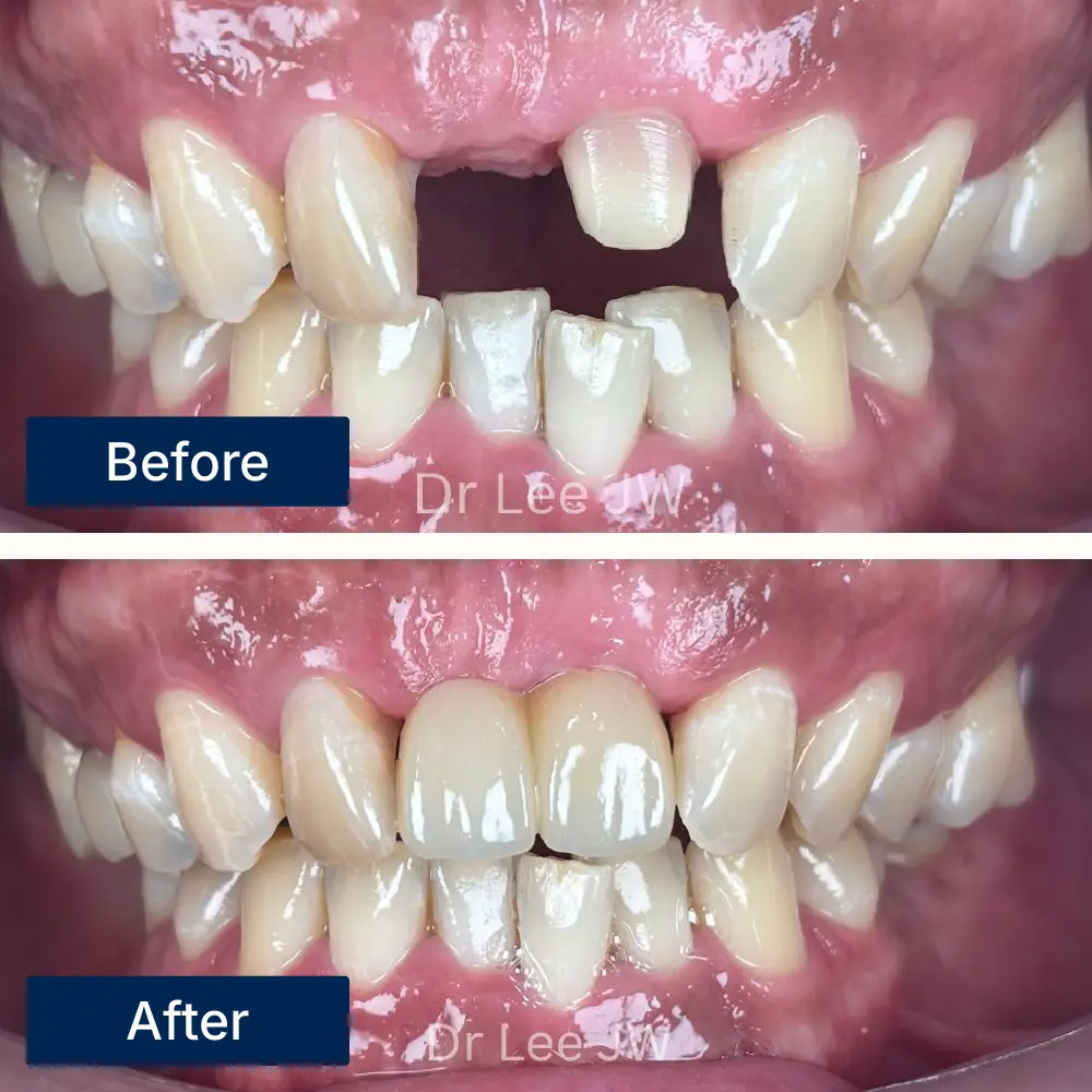 Before: Visible gap from missing tooth before dental bridge placement at Oralis Dental, Petaling Jaya. After: Natural-looking dental bridge replacing missing tooth after treatment at Oralis Dental — improved bite and smile symmetry.
