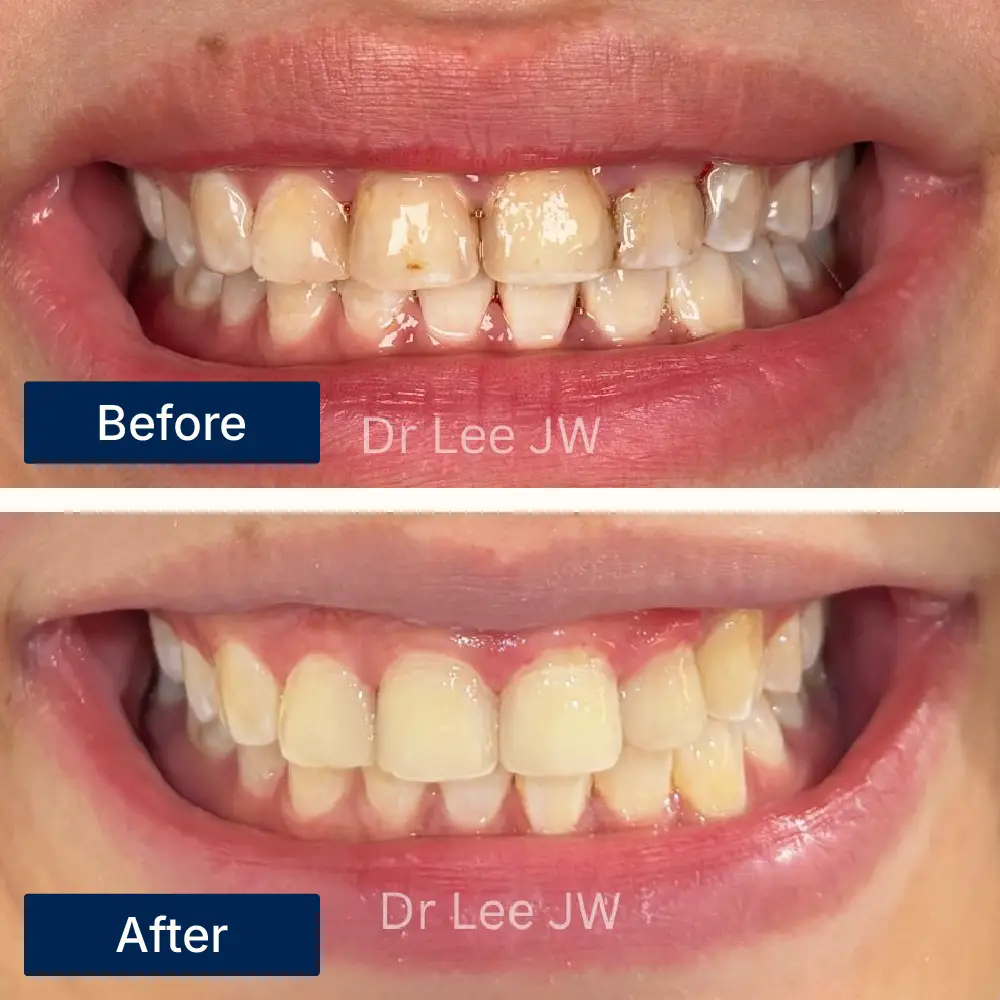 Before: Teeth with uneven shape and color before veneer placement at Oralis Dental, Petaling Jaya. After: Symmetrical, natural-looking teeth after porcelain veneers at Oralis Dental — enhanced smile design.