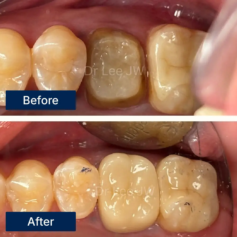 Before: Molars with visible decay and damage before dental crown treatment at Oralis Dental, Petaling Jaya. After: Molars restored with dental crowns after treatment at Oralis Dental — improved strength and natural appearance.