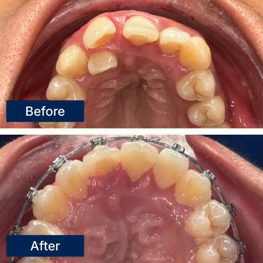 Before: Severely crowded teeth before Damon braces treatment at Oralis Dental, Petaling Jaya. After: Well-aligned teeth after Damon braces at Oralis Dental — efficient orthodontic correction with reduced friction.