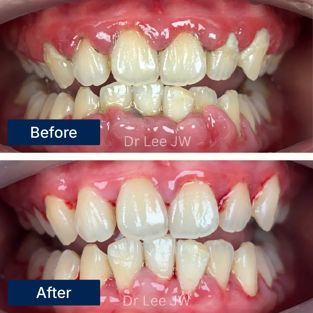 Before: Teeth with heavy plaque and inflamed gums before deep scaling treatment at Oralis Dental, Petaling Jaya. After: Cleaner teeth and healthier gums after deep scaling at Oralis Dental — improved oral hygiene and reduced inflammation.