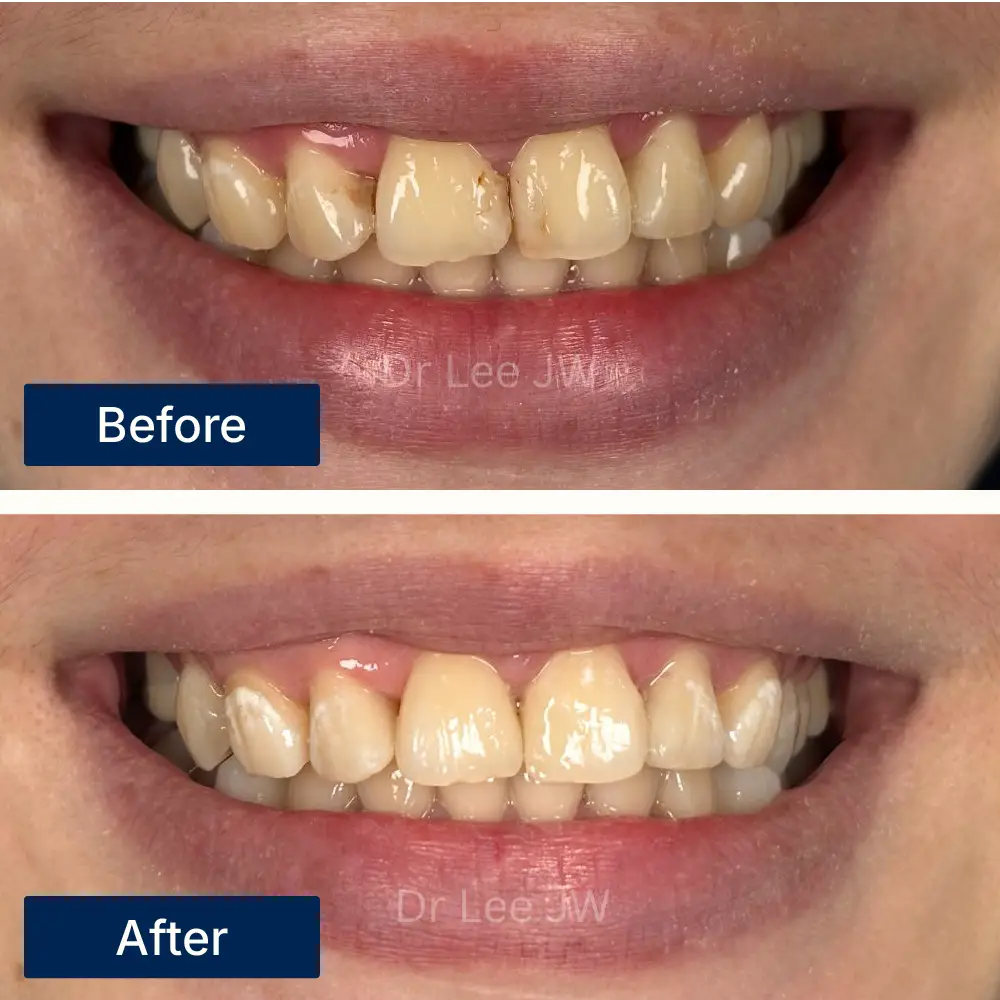 Before: Close-up of teeth with cavities and decay before dental fillings at Oralis Dental, Petaling Jaya. After: Restored teeth with smooth, natural-looking fillings after treatment at Oralis Dental — improved function and aesthetics.