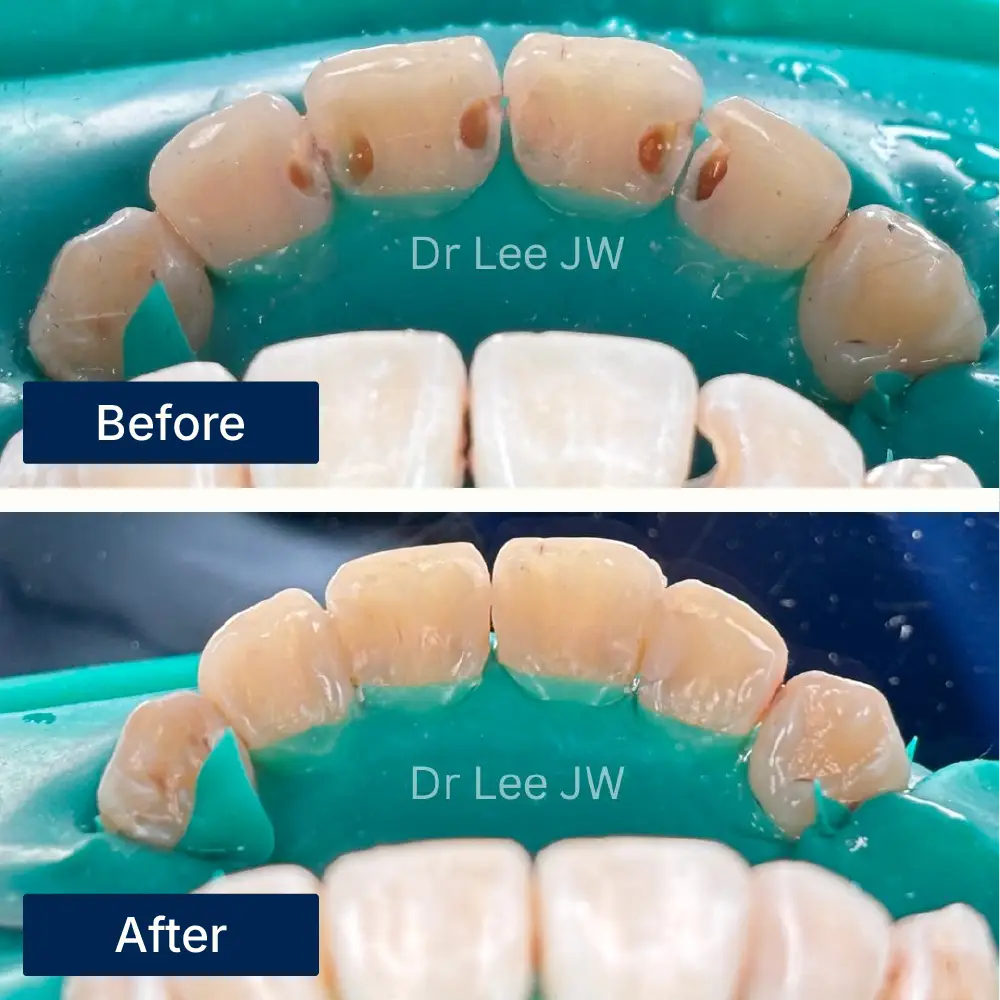 Before: Close-up of teeth with cavities and damage before dental fillings at Oralis Dental, Petaling Jaya. After: Restored teeth with natural-looking fillings after treatment at Oralis Dental — improved function and aesthetics.