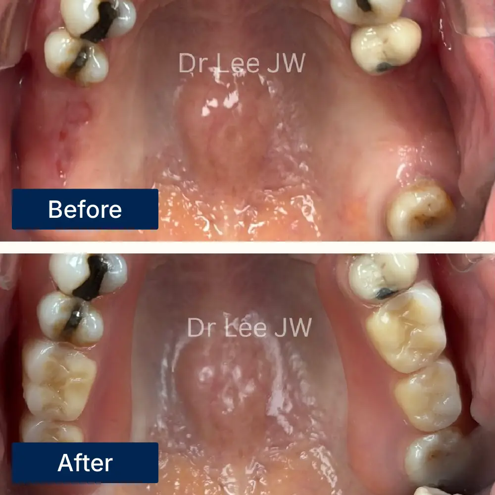 Before: Upper jaw with multiple missing teeth before flexible denture fitting at Oralis Dental, Petaling Jaya. After: Flexible partial denture in place after treatment at Oralis Dental — discreet, comfortable restoration of missing teeth.