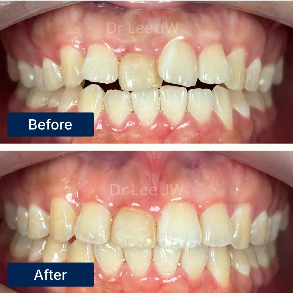 Before: Mild to moderate tooth misalignment before Invisalign® treatment at Oralis Dental, Petaling Jaya. After: Discreetly aligned teeth after Invisalign® clear aligner therapy at Oralis Dental — improved smile and comfort.