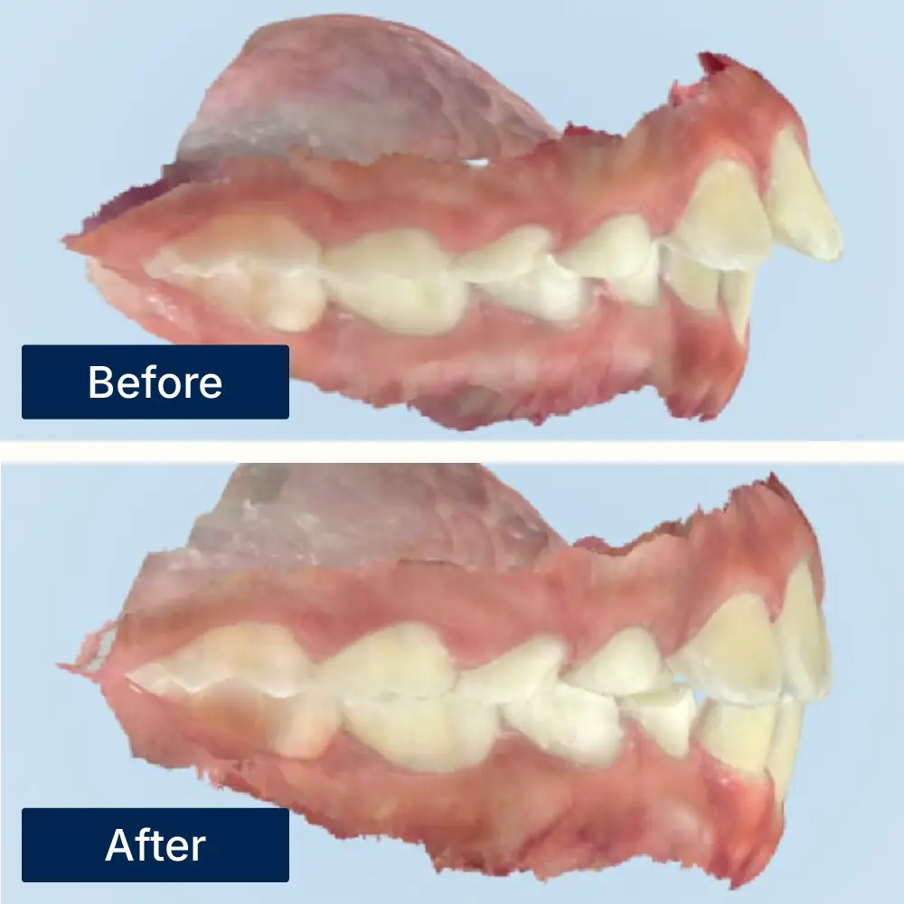 Before: Digital dental scan showing misaligned teeth and overjet before Myobrace myofunctional therapy at Oralis Dental, Petaling Jaya. After: Improved bite and aligned teeth after Myobrace therapy at Oralis Dental — enhanced jaw development and occlusion.
