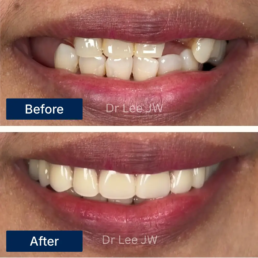 Before: Mouth with missing teeth before partial denture fitting at Oralis Dental, Petaling Jaya. After: Restored smile with partial dentures after treatment at Oralis Dental — improved alignment and appearance.