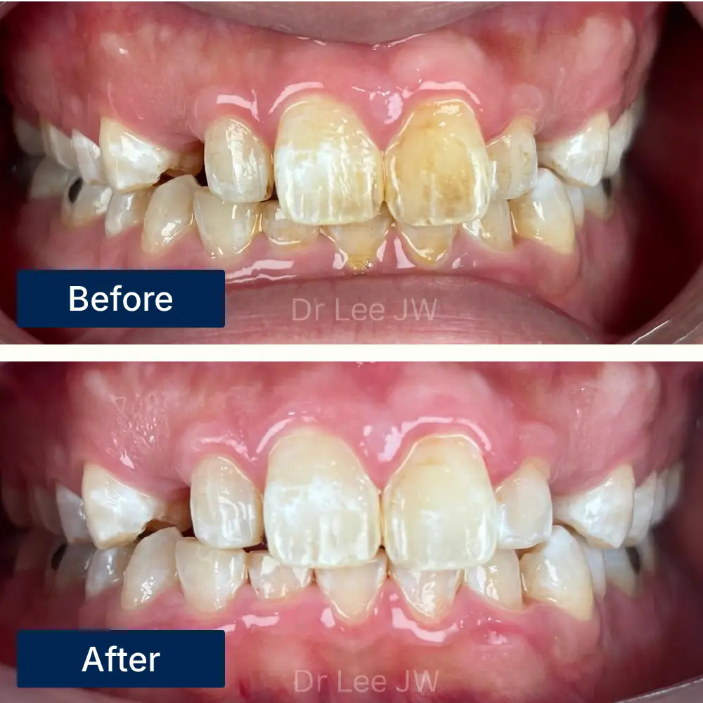 Before: Teeth with surface stains from smoking before air polishing at Oralis Dental, Petaling Jaya. After: Brighter, stain-free teeth after air polishing treatment at Oralis Dental — enhanced smile clarity.