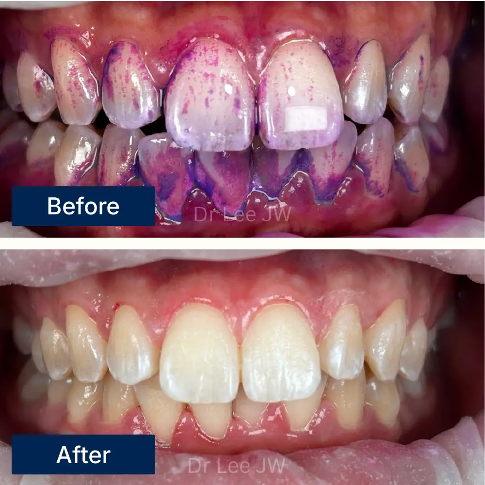 Before: Teeth with visible plaque buildup before scaling treatment at Oralis Dental, Petaling Jaya. After: Cleaner, whiter teeth after professional scaling at Oralis Dental — improved oral hygiene and appearance.