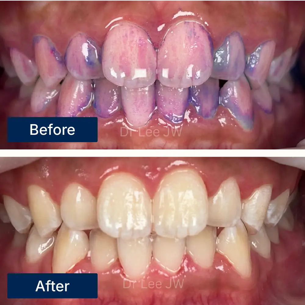 Before: Teeth with visible plaque and discoloration before scaling treatment at Oralis Dental, Petaling Jaya. After: Cleaner, whiter teeth after professional scaling at Oralis Dental, Petaling Jaya — plaque removal and improved oral hygiene.