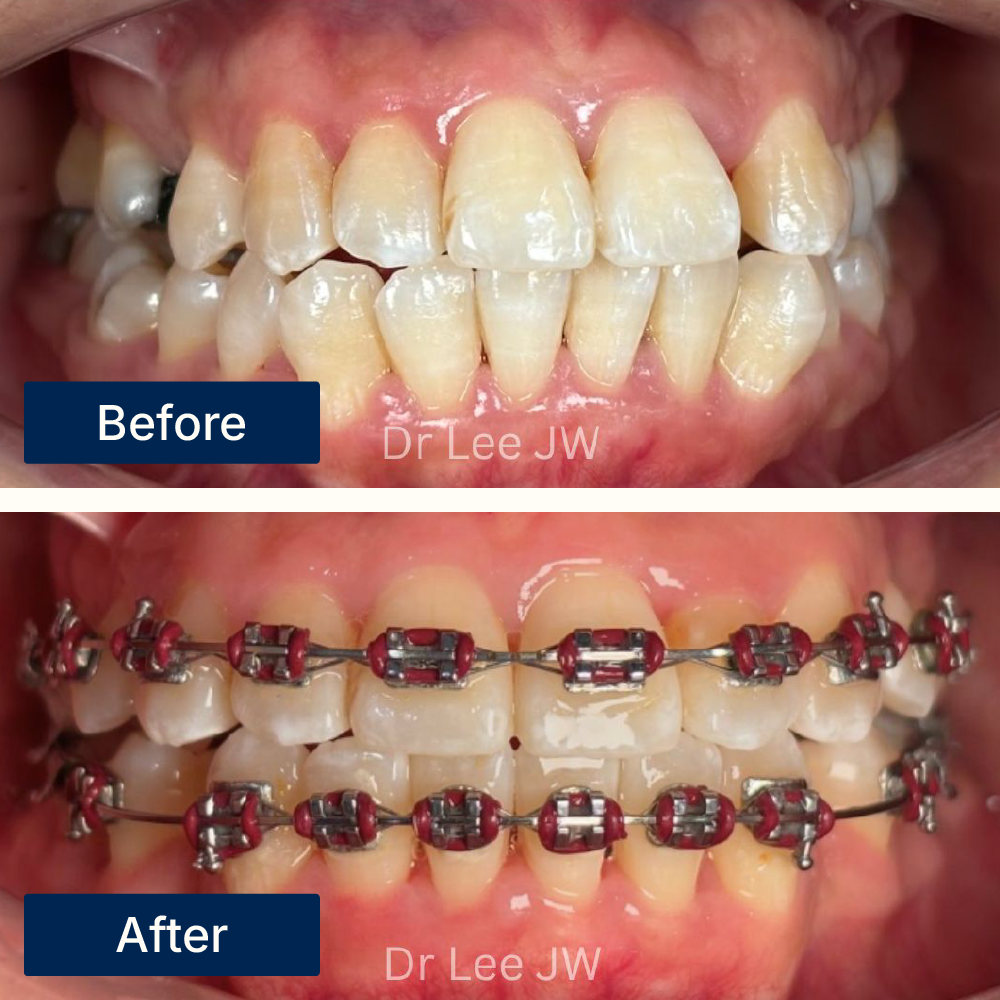 Before: Crowded and misaligned teeth before traditional braces treatment at Oralis Dental, Petaling Jaya. After: Straightened teeth with improved bite after traditional braces at Oralis Dental — enhanced alignment and function.