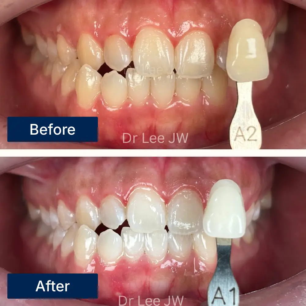 Before: Teeth with surface stains and discoloration before whitening treatment at Oralis Dental, Petaling Jaya. After: Brighter, whiter teeth after professional whitening at Oralis Dental — enhanced smile aesthetics.