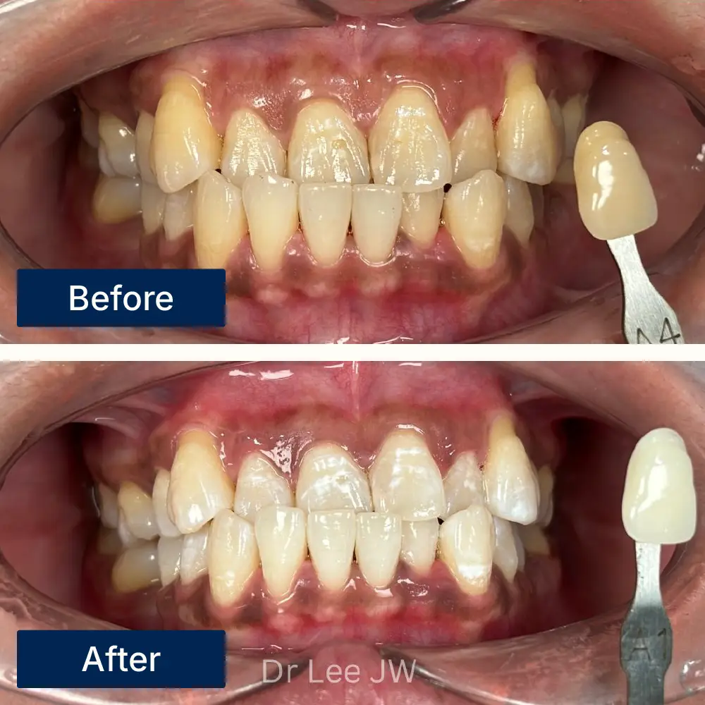 Before: Teeth with surface stains and discoloration before whitening treatment at Oralis Dental, Petaling Jaya. After: Brighter, whiter teeth after professional whitening at Oralis Dental — enhanced smile aesthetics.
